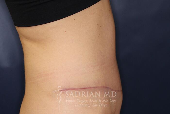 Tummy Tuck Before & After Image