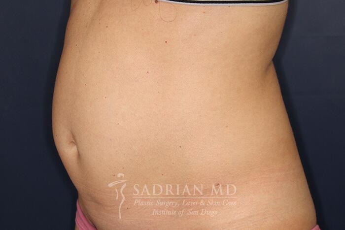 Tummy Tuck Before & After Image