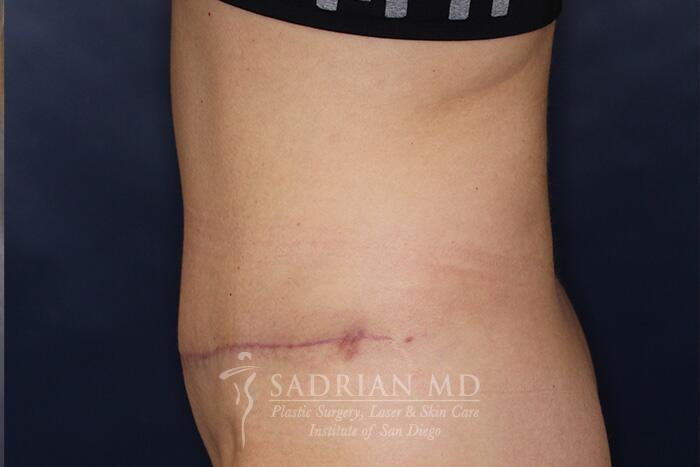 Tummy Tuck Before & After Image