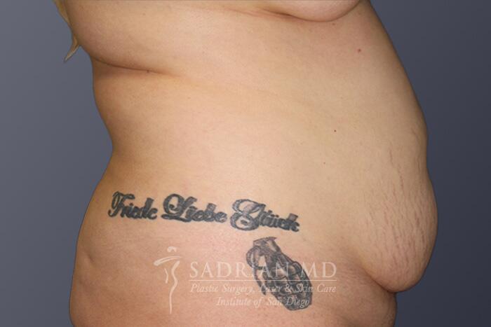 Tummy Tuck Before & After Image