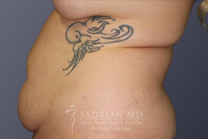 Tummy Tuck Before & After Image