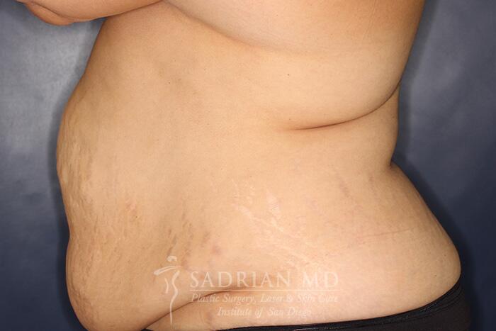 Tummy Tuck Before & After Image