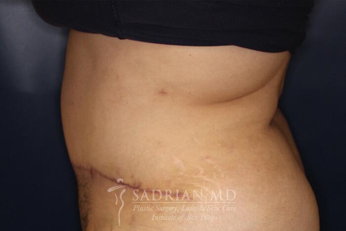 Tummy Tuck Before & After Image