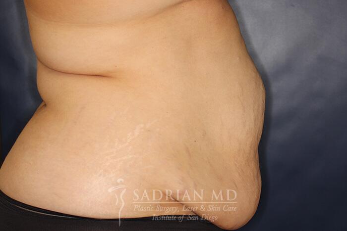 Tummy Tuck Before & After Image