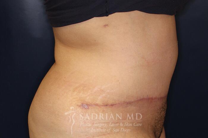 Tummy Tuck Before & After Image