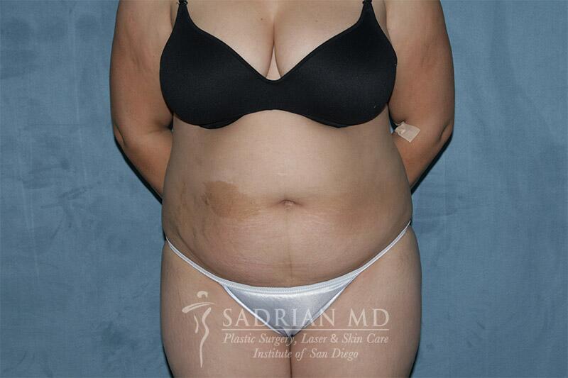 Tummy Tuck Before & After Image