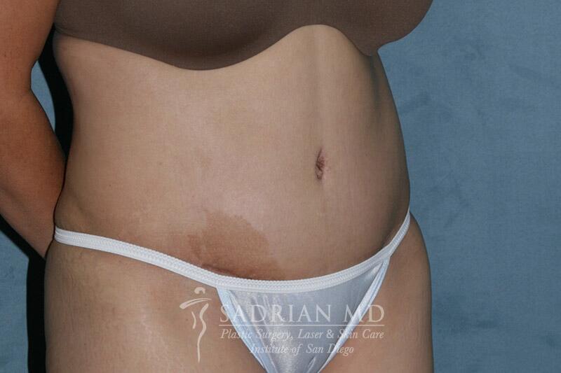 Tummy Tuck Before & After Image