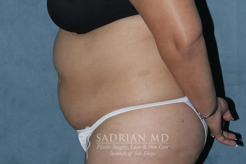 Tummy Tuck Before & After Image