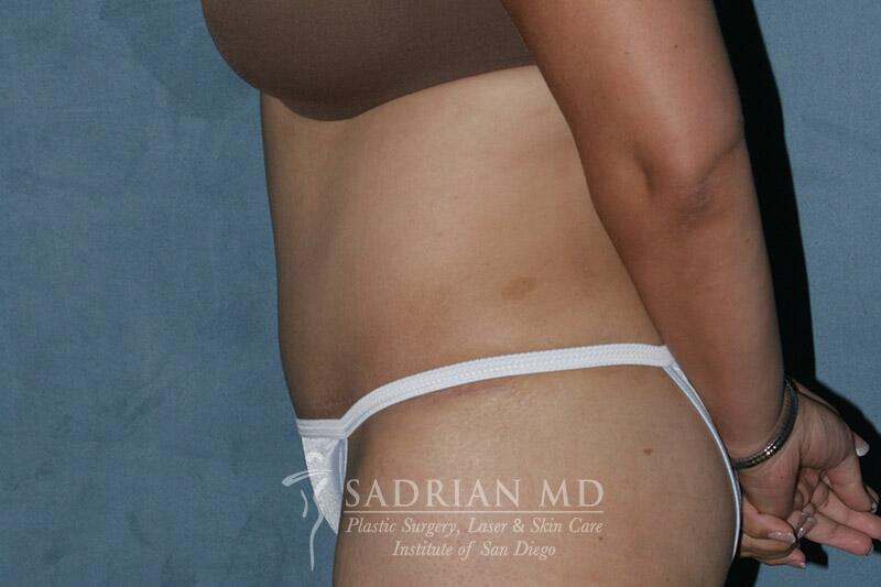 Tummy Tuck Before & After Image