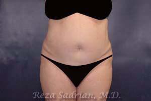 Tummy Tuck Before & After Image