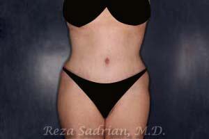 Tummy Tuck Before & After Image