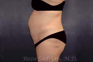 Tummy Tuck Before & After Image