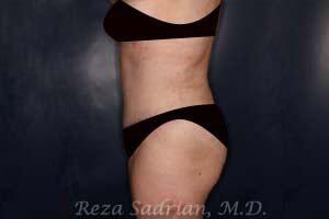 Tummy Tuck Before & After Image