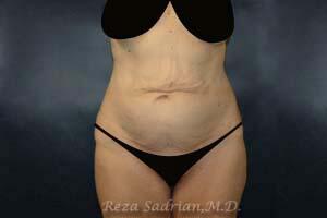 Tummy Tuck Before & After Image