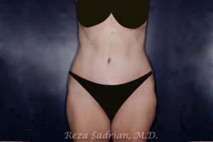 Tummy Tuck Before & After Image