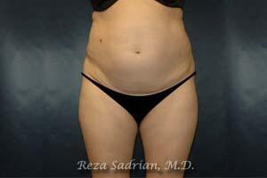 Tummy Tuck Before & After Image