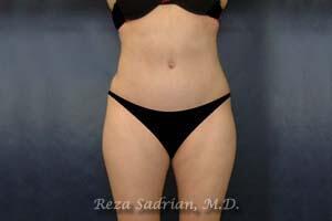 Tummy Tuck Before & After Image