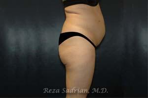 Tummy Tuck Before & After Image