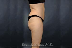 Tummy Tuck Before & After Image