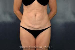 Tummy Tuck Before & After Image