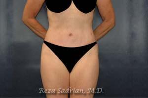 Tummy Tuck Before & After Image