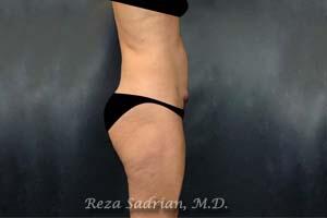 Tummy Tuck Before & After Image