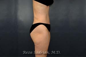 Tummy Tuck Before & After Image