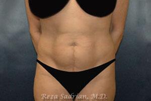 Tummy Tuck Before & After Image