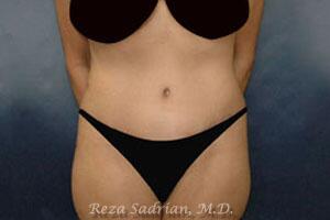 Tummy Tuck Before & After Image