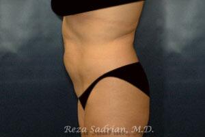 Tummy Tuck Before & After Image