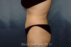 Tummy Tuck Before & After Image