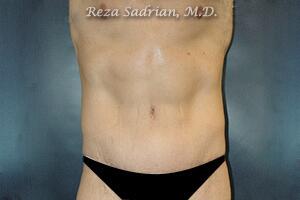 Tummy Tuck Before & After Image