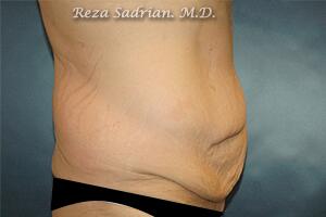 Tummy Tuck Before & After Image