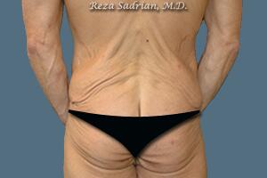 Tummy Tuck Before & After Image