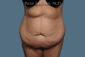 Tummy Tuck Before & After Image