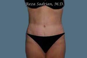 Tummy Tuck Before & After Image