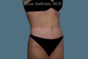 Tummy Tuck Before & After Image