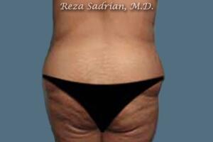 Tummy Tuck Before & After Image