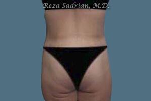 Tummy Tuck Before & After Image