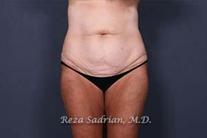 Tummy Tuck Before & After Image