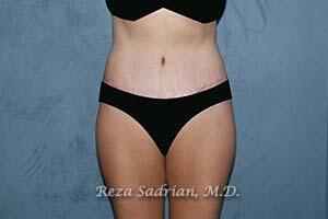 Tummy Tuck Before & After Image