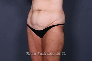 Tummy Tuck Before & After Image