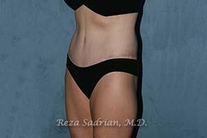 Tummy Tuck Before & After Image