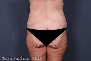 Tummy Tuck Before & After Image