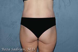 Tummy Tuck Before & After Image