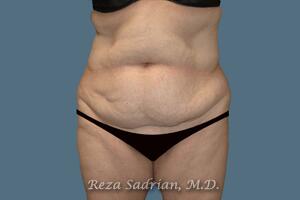 Tummy Tuck Before & After Image