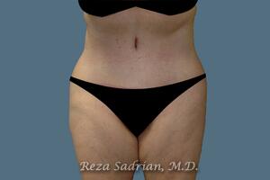 Tummy Tuck Before & After Image