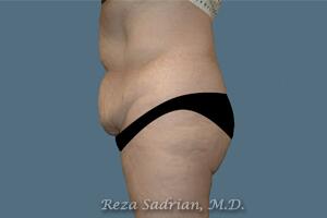 Tummy Tuck Before & After Image