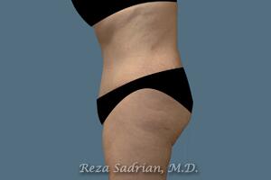 Tummy Tuck Before & After Image