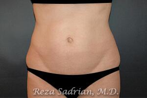 Tummy Tuck Before & After Image